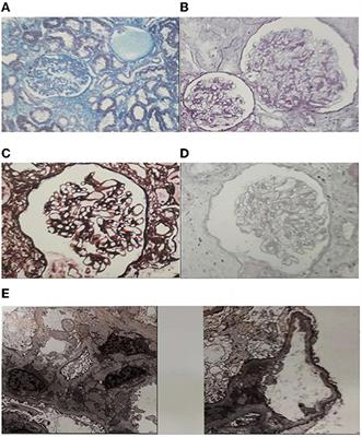 A Case Report and Literature Review of Oligomeganephronia